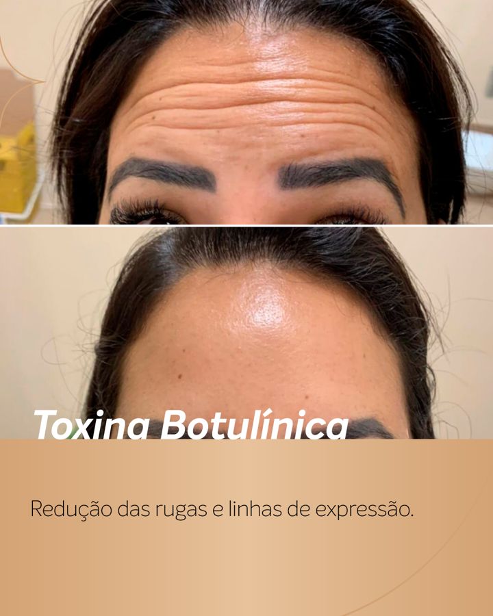 Antes e depois - Toxina Botulínica