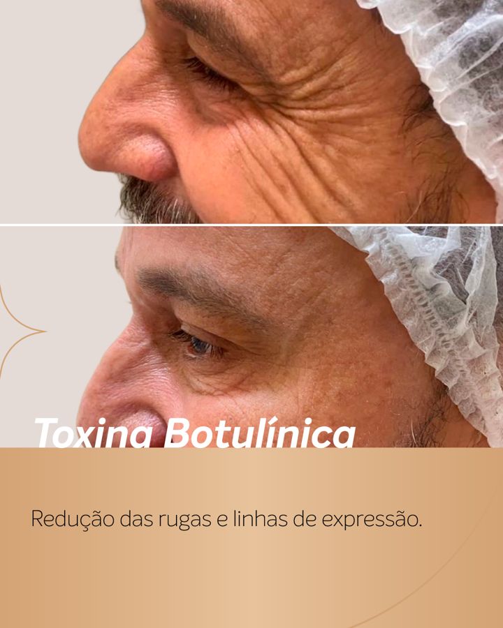 Antes e depois - Toxina Botulínica