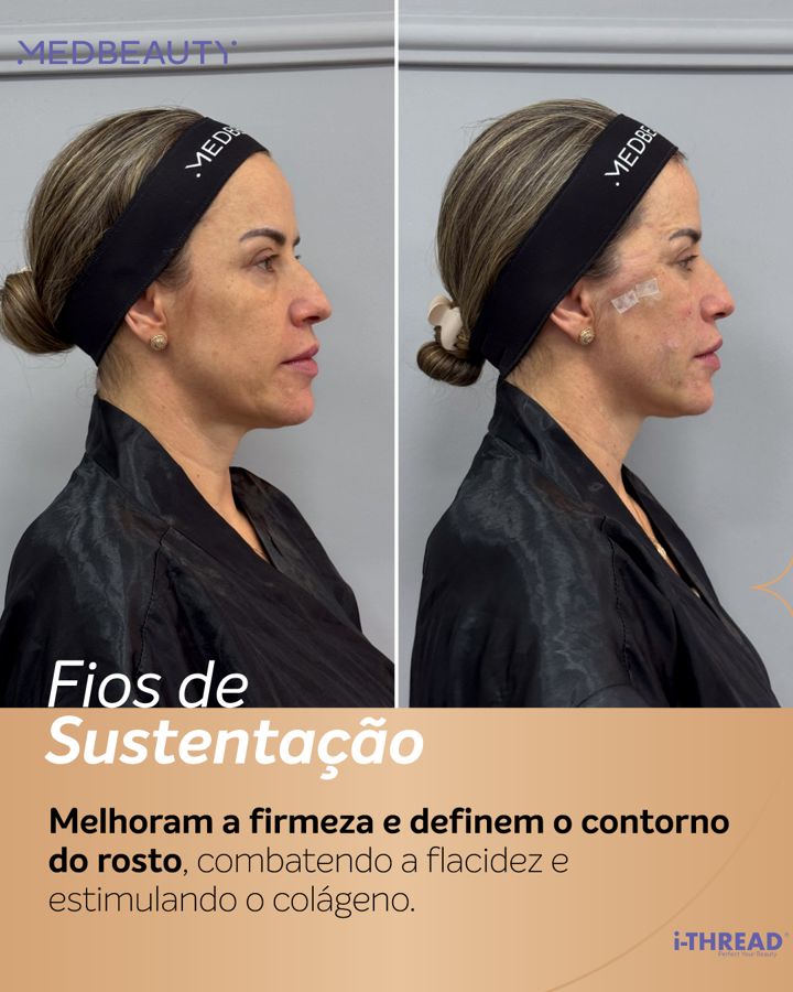 Antes e depois - Fios de Sustentação