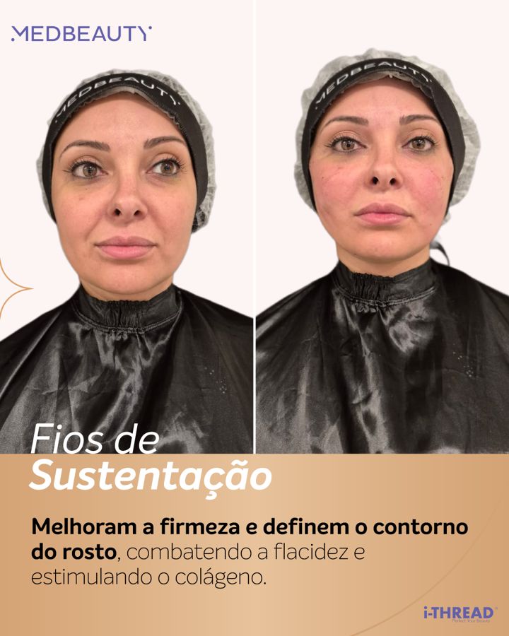Antes e depois - Fios de Sustentação