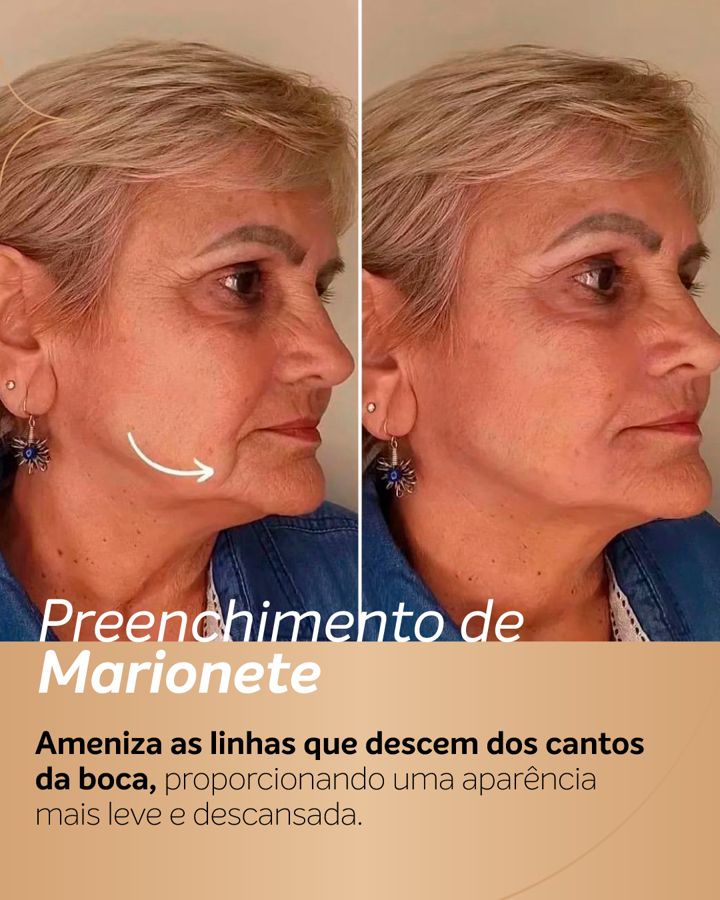 Antes e depois - Preenchimento de Marionete