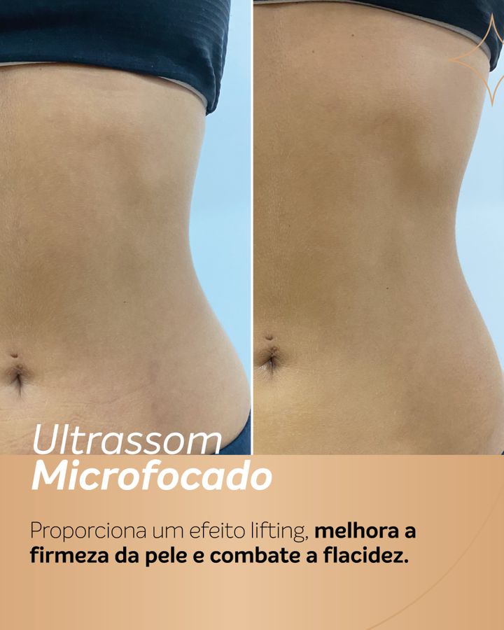 Antes e depois - Ultrassom Microfocado