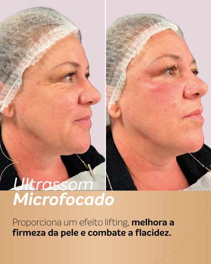 Antes e depois - Ultrassom Microfocado