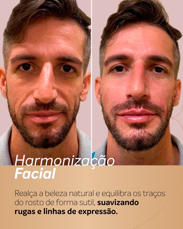 Antes e depois - Harmonização Facial
