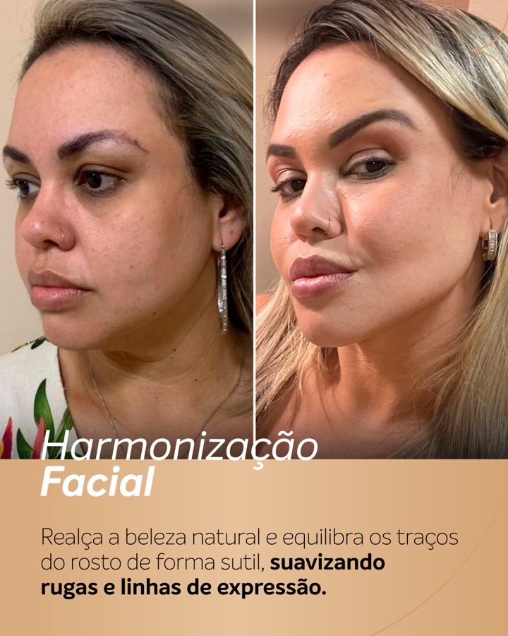 Antes e depois - Harmonização Facial