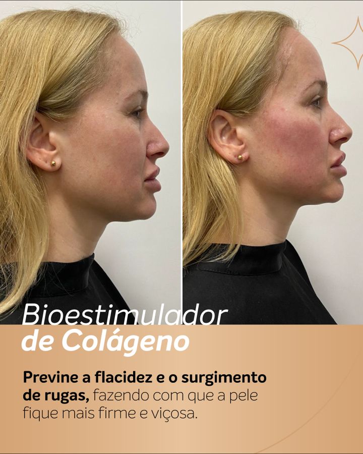 Antes e depois - Bioestimulador de Colágeno
