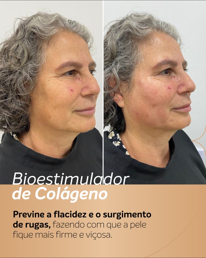 Antes e depois - Bioestimulador de Colágeno