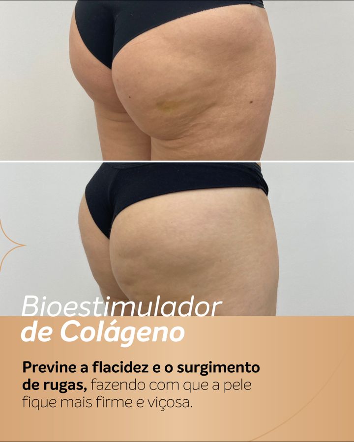 Antes e depois - Bioestimulador de Colágeno